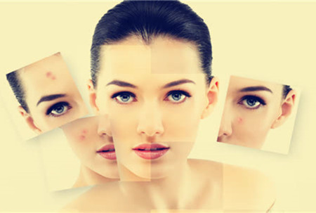 祛痘也要將就方法，不然后果很嚴(yán)重