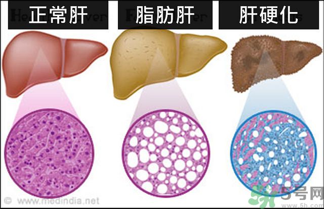 得了脂肪肝該怎么治？脂肪肝對人體危害有多大？