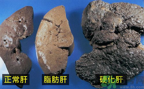 得了脂肪肝該怎么治？脂肪肝對人體危害有多大？