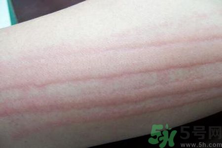 蕁麻疹會不會傳染？蕁麻疹怎么治才能好？