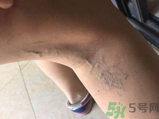40歲女性小腿靜脈曲張怎么辦？