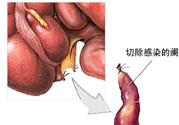 闌尾手術(shù)會(huì)影響結(jié)腸嗎？闌尾手術(shù)術(shù)后要注意什么？