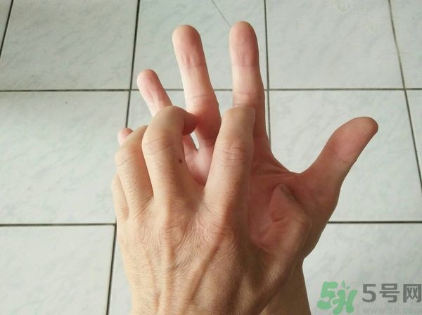 手上起水泡是什么原因？怎樣預防手上起水泡？