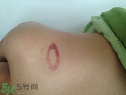 種草莓吻痕是什么意思？吻痕是怎么弄出來的？