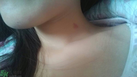 種草莓吻痕是什么意思？吻痕是怎么弄出來的？