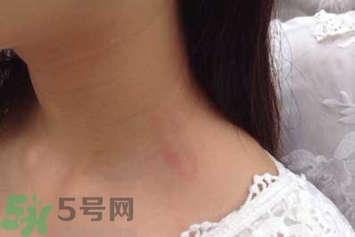 種草莓吻痕是什么意思？吻痕是怎么弄出來的？