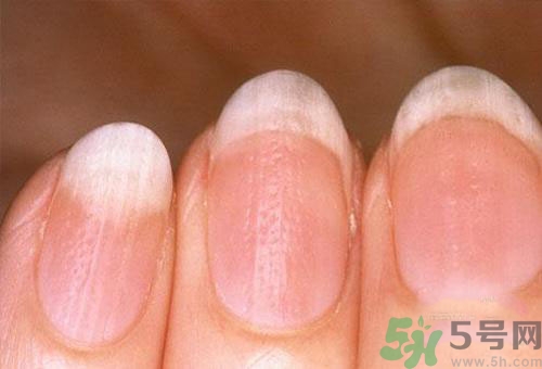 指甲發(fā)白是怎么回事？指甲發(fā)白代表什么？