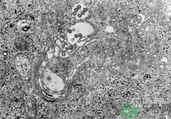 裂谷熱病怎么治？裂谷熱病的癥狀有哪些？