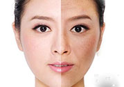 激光美白有用嗎？激光美白可以維持多久？