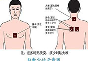 腰痛貼三伏貼有用嗎？腰痛三伏貼貼哪個(gè)穴位？