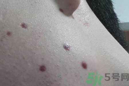 激光點(diǎn)痣后可以洗臉嗎？激光點(diǎn)痣后需要注意什么？
