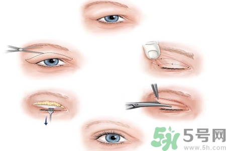 割雙眼皮分哪幾種？割雙眼皮需要多少錢？