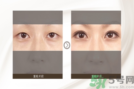 割雙眼皮分哪幾種？割雙眼皮需要多少錢？