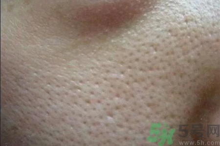 皮膚毛孔粗大原因有哪些？如何預(yù)防皮膚毛孔粗大？