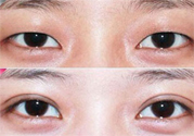 割雙眼皮分哪幾種？割雙眼皮需要多少錢？