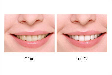 冷光美白牙齒可以保持多長(zhǎng)時(shí)間？冷光美白牙齒有副作用嗎？