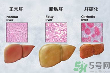 妊娠急性脂肪肝是什么？妊娠急性脂肪肝的治療方法？