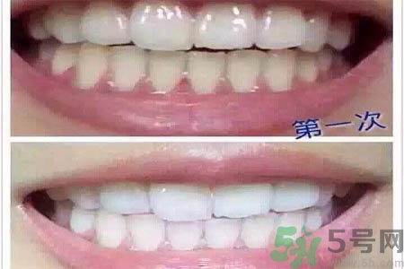 冷光美白牙齒的價格是多少？做冷光美白牙齒需要多少錢？