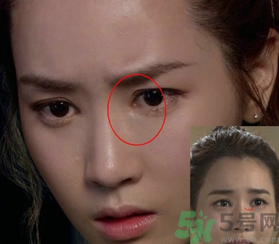 開眼角多少錢？開眼角有什么危害？