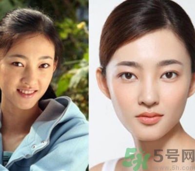 開眼角眼睛會(huì)變大嗎？開眼角眼睛能大多少？