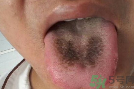 舌頭發(fā)黑怎么回事？舌頭發(fā)黑怎么辦？