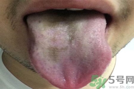 舌頭發(fā)黑怎么回事？舌頭發(fā)黑怎么辦？