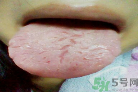 舌頭上有裂紋是怎么辦？舌頭上有裂紋是什么原因？