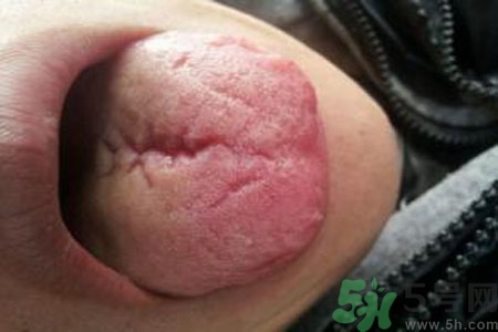 舌頭上有裂紋是怎么辦？舌頭上有裂紋是什么原因？