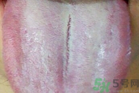 舌頭發(fā)白是什么原因？舌苔發(fā)白是怎么辦？