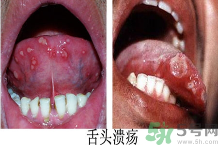 舌頭潰瘍?cè)趺崔k？舌頭潰瘍的原因？