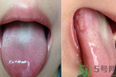 舌頭潰瘍?cè)趺崔k？舌頭潰瘍的原因？