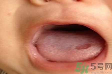 舌頭潰瘍?cè)趺崔k？舌頭潰瘍的原因？