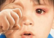 寶寶得了紅眼病怎么辦？寶寶得了紅眼病怎么治？