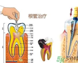 什么是根管治療？為什么牙齒疼要做根管治療？