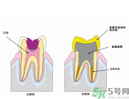 什么是根管治療？為什么牙齒疼要做根管治療？