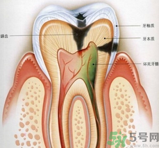 什么是根管治療？為什么牙齒疼要做根管治療？