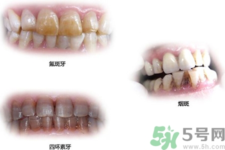 四環(huán)素牙是什么？四環(huán)素牙是怎么形成的？