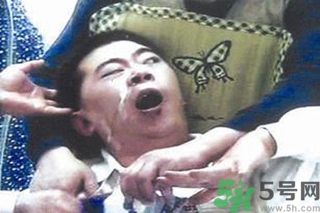 癲癇的典型癥狀有哪些？癲癇是什么？