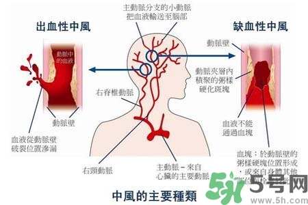 腦中風(fēng)是什么？腦中風(fēng)的癥狀？