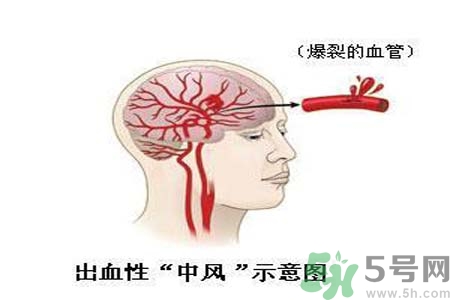 腦中風(fēng)的護(hù)理措施？腦中風(fēng)的飲食護(hù)理？