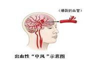 腦中風(fēng)的發(fā)病因素？腦中風(fēng)的并發(fā)癥有哪些 ？