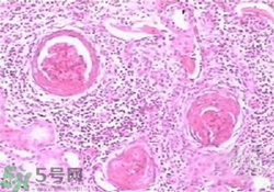 慢性腎炎能治好嗎？慢性腎炎能活多久？