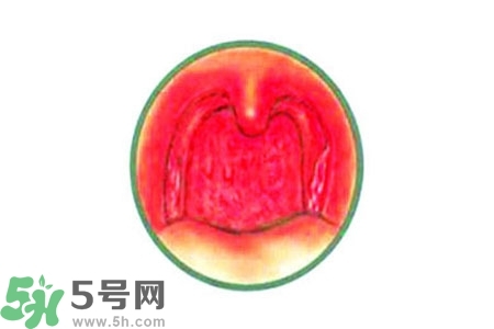 慢性咽炎的治療方法？慢性咽炎的藥物治療？