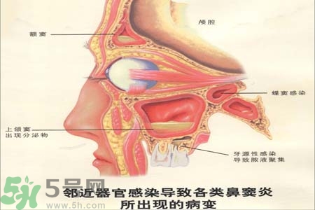 鼻竇炎是什么？鼻竇炎的癥狀有哪些？