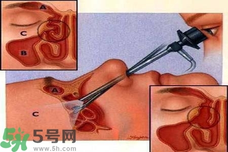 鼻竇炎的高發(fā)人群？如何預(yù)防鼻竇炎？