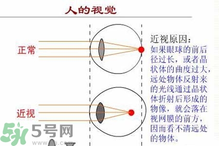 近視眼的發(fā)病因素？近視眼的并發(fā)癥有哪些？