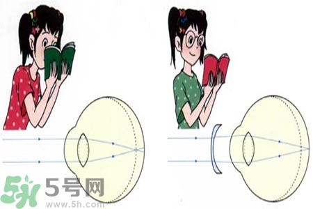 近視眼的發(fā)病因素？近視眼的并發(fā)癥有哪些？