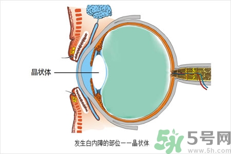 白內(nèi)障的護(hù)理措施是什么？白內(nèi)障的飲食護(hù)理有哪些？