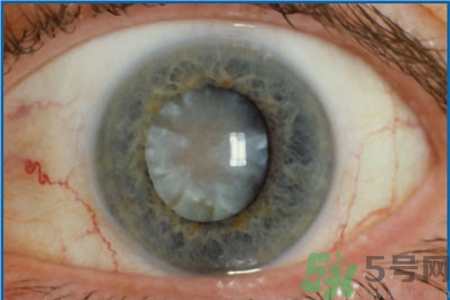 白內(nèi)障治療方法是什么？白內(nèi)障可以用什么藥物治療？