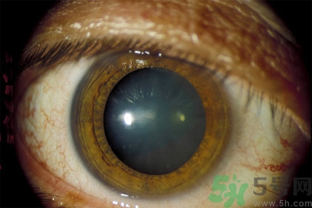 白內(nèi)障治療方法是什么？白內(nèi)障可以用什么藥物治療？